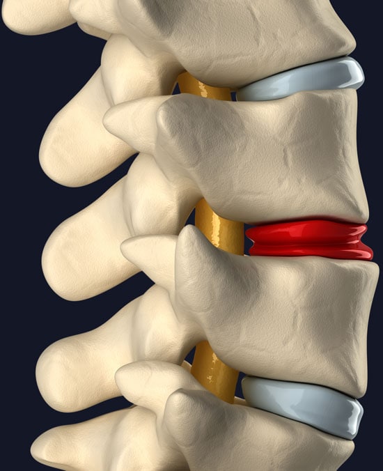 Regenexx Procedures for Spine Conditions